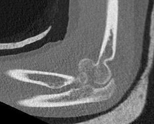 Capitellar Fracture CT Sagittal
